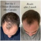 Ultimate Hair Restoration For Men